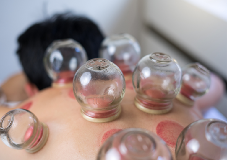 Hijama: 10 Amazing Insights into the World of cupping therapy.