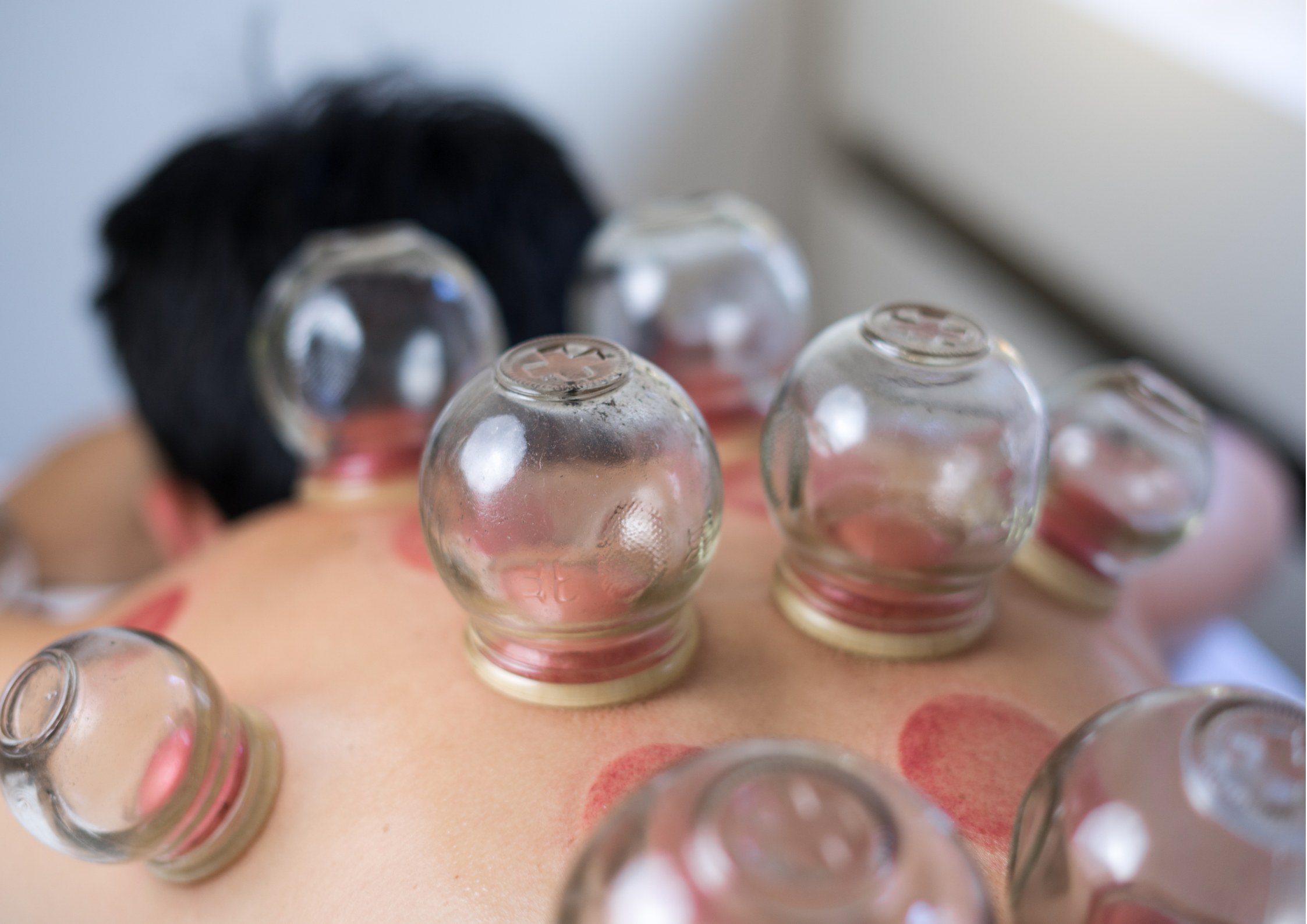 Hijama Therapy