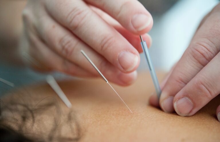 9 Misguided Myths on Acupuncture: Empowering Truths Demystified